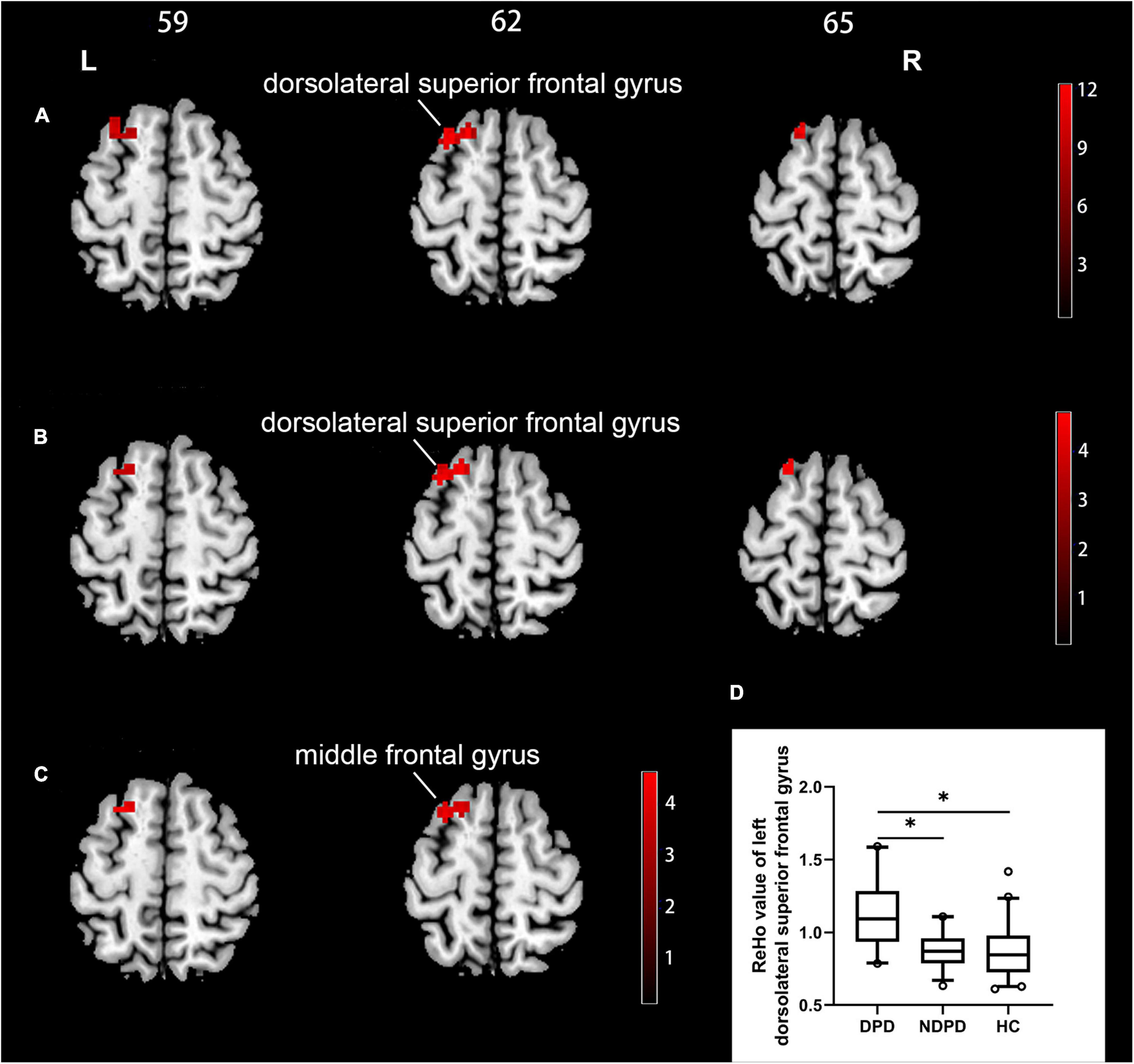 Functional and structural alterations as diagnostic imaging markers for depression in de novo Parkinson’s disease